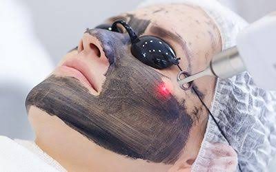 Carbon kuorinta laserilla – Mistä on kyse – kuva 4