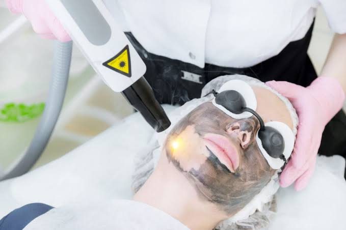 Carbon kuorinta laserilla – Mistä on kyse – kuva 7