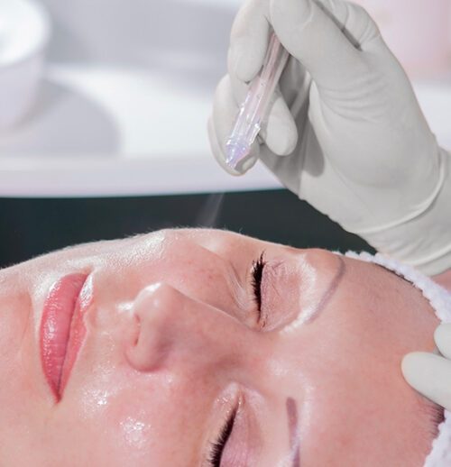 Oxygen Jet Peel – Mistä on kyse – kuva 7