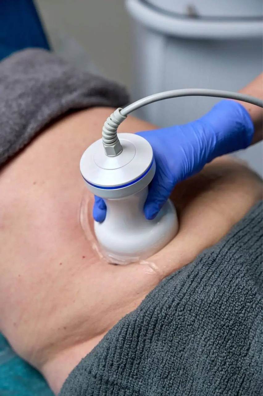Rasvanpoisto ultraäänellä – Tausta – kuva 1